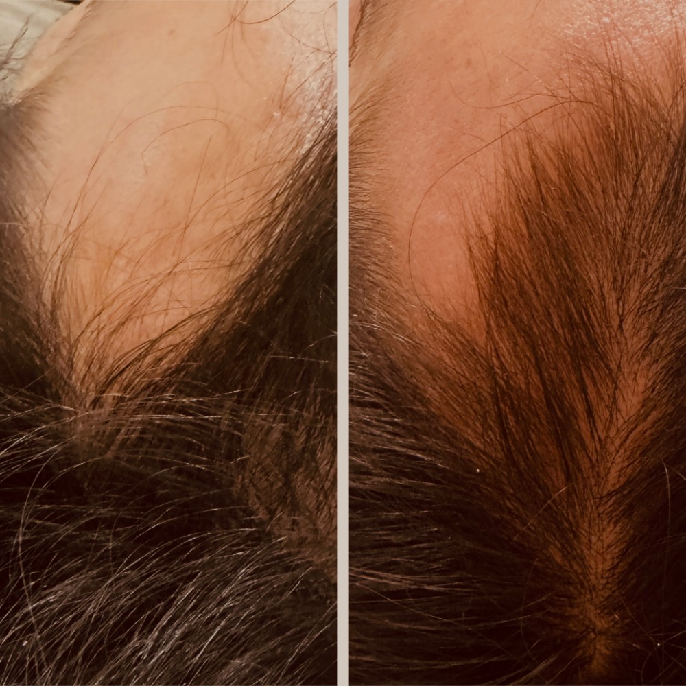 Mesoterapia capilar