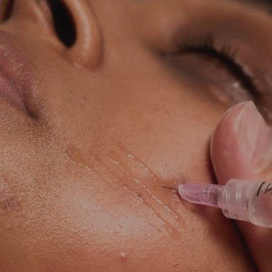 Mesoterapia facial